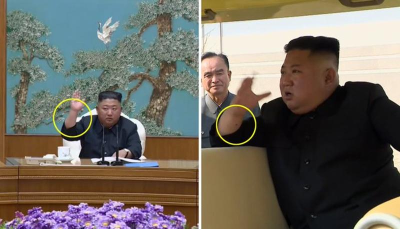 Dấu chấm đen trên tay ông Kim ngày 2-5 không được nhìn thấy trong lần xuất hiện hôm 11-4. 